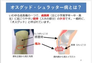 成長痛（オスグッド・シュラッター病)